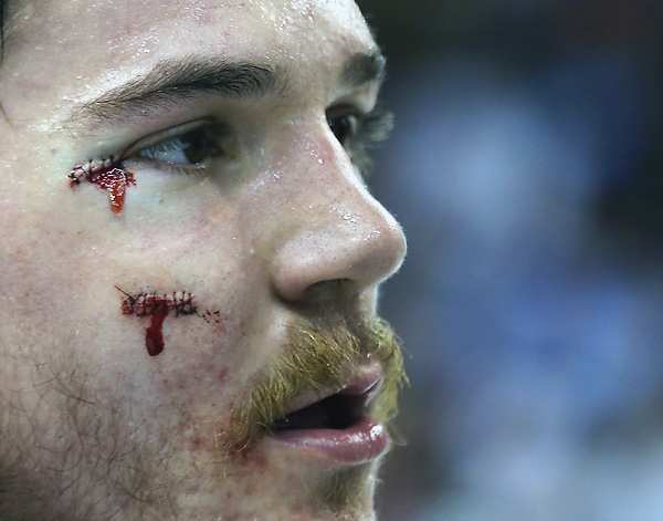 You know you want to bid on Andrew Shaw's stitches, right?
